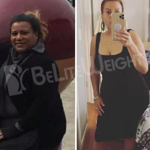 Weight Loss Surgery Before and After Anniuska M - 2 Year Update*